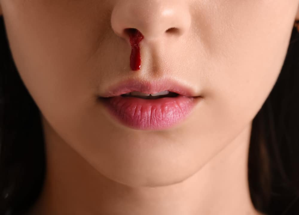 Posebni savjeti za krvarenje iz nosa kod djece